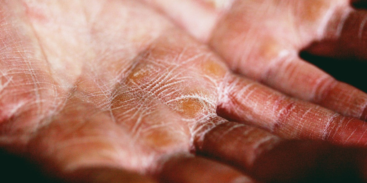 CBD Oil for Dry Skin: The Research is Surprising